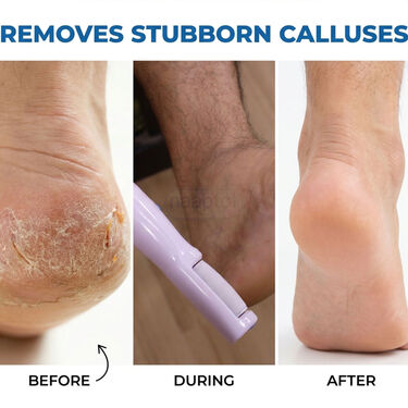 Rechargeable Dead Skin Remover For Feet (RFF7)